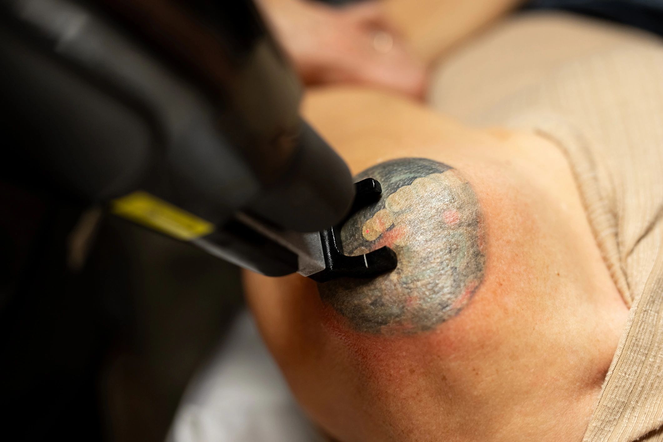 Tattoo removal treatment